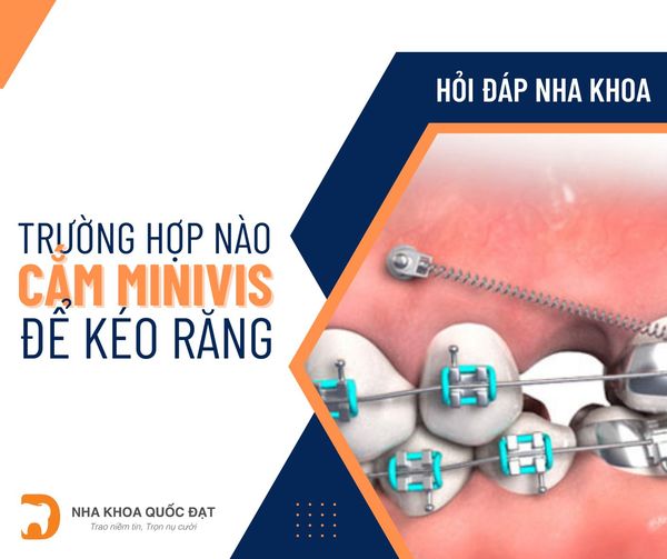 chỉnh nha mắc cài