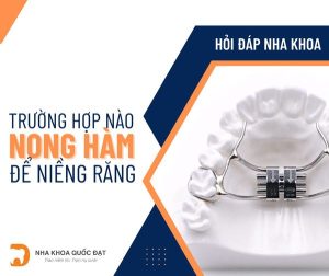 Chỉnh nha trả góp