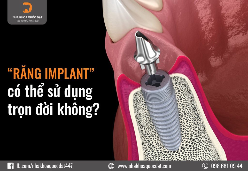 cấy ghép implant