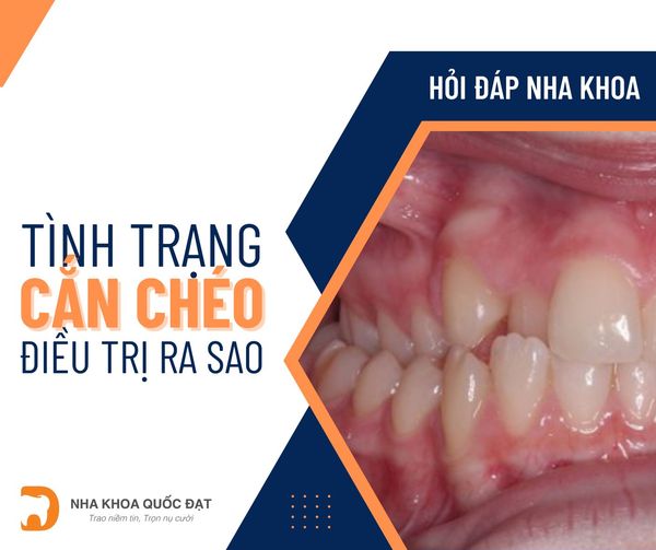 niềng răng trả góp